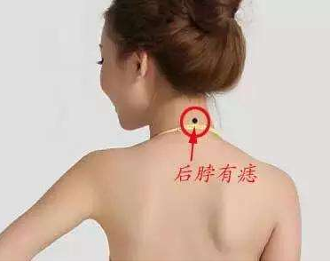 脖子后面有痣代表什么,男女脖子后面有痣图解 脖子后面有痣代表什么,男女脖子后面有痣图解