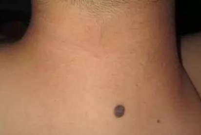 脖子后面有痣好吗，脖子后面的苦情痣有什么说法