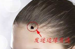 头发边缘有痣代表什么,发际线上有痣命运如何 头发边缘有痣代表什么,发际线上有痣命运如何
