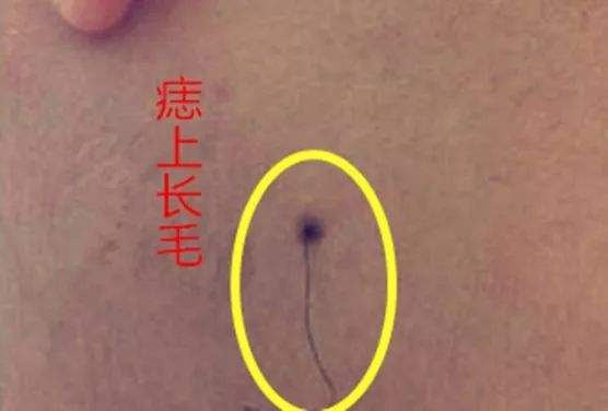 痣毛剪掉会影响运气吗，破坏运气的痣长在哪里